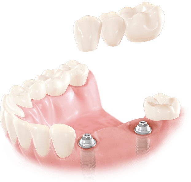 05 protesis sebre implants_A tratamiento con implante varios neodent protesis sebre implantes - Barcelona y Manresa