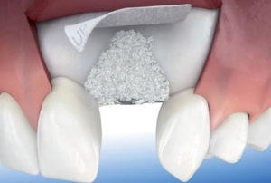 Regeneración ósea para implantes dentales – Barcelona y Manresa Implantes dentales para pacientes con poco hueso
