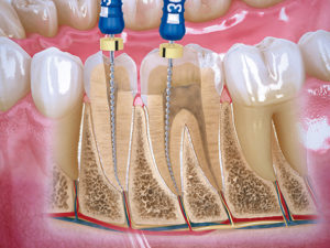 endodoncia-clinica-dental-enric-pintado-barcelona-manresa Qué es un implante dental. Imagen de implante dental unitario.