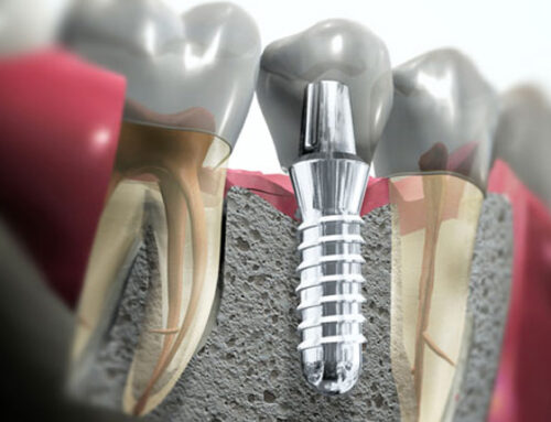 ¿CÓMO HAY QUE CUIDAR LOS IMPLANTES DENTALES?