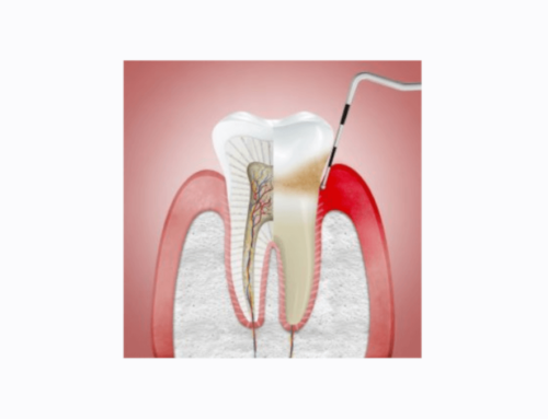 Apretar los dientes. ¿QUÉ ES EL BRUXISMO?