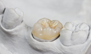 Qué es un implante dental. Imagen de implante dental unitario.