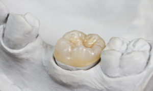 Incrustación – Clínica Dental Enric Pintado – Barcelona y Manresa Qué es un implante dental. Imagen de implante dental unitario.