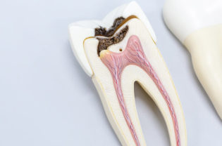 endodoncia-dental-enric-pintado