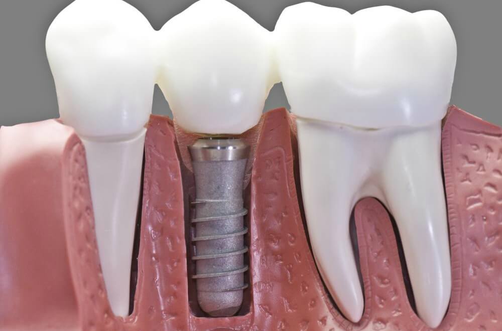 implantes-dentales-enric-pintado