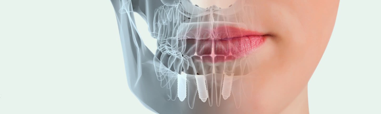 implantes-dentales-ventajas