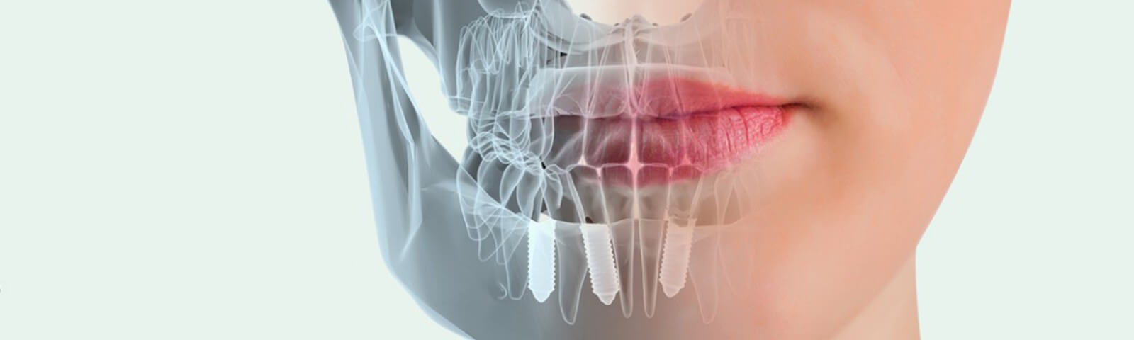 implantes-dentales-ventajas implantes-dentales-ventajas
