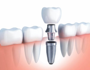 implantologia-avanzada Qué es un implante dental. Imagen de implante dental unitario.