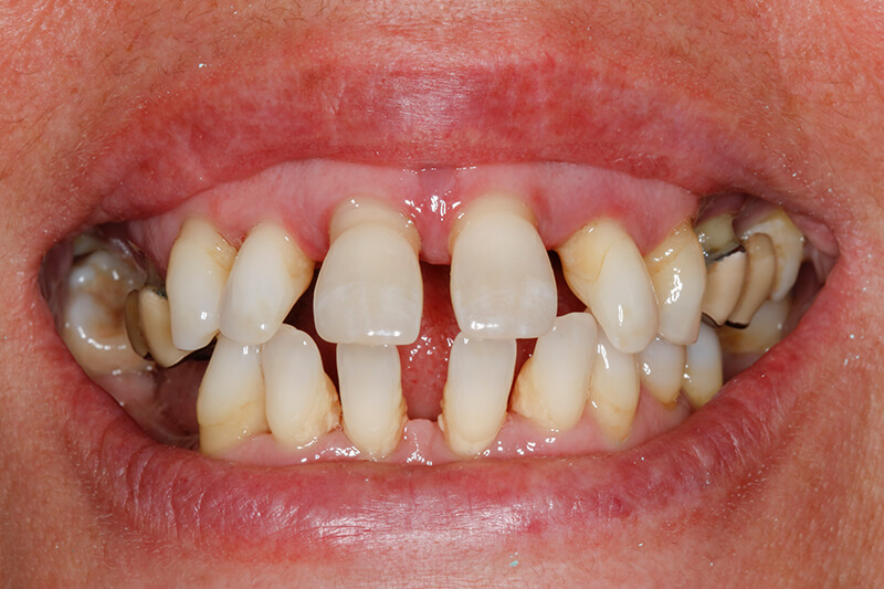 implantes-dentales-barcelona-manresa-antes