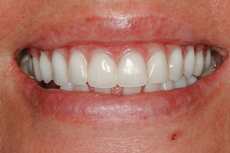 implantes-dentales-barcelona-manresa-despues
