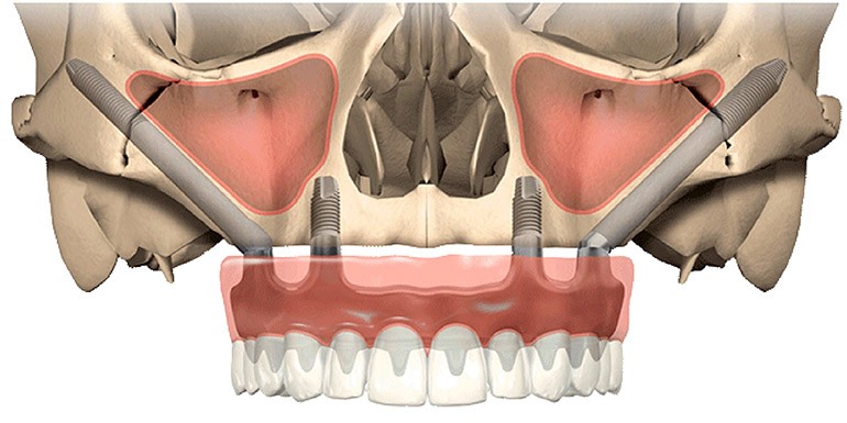 Implantes Cigomáticos sin hueso Barcelona