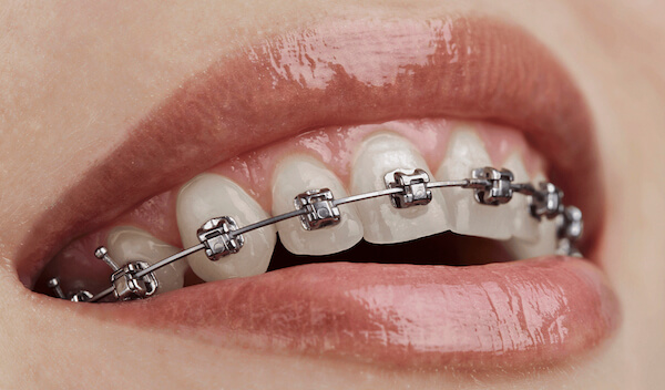 Ortodoncia con Brackets Metálicos