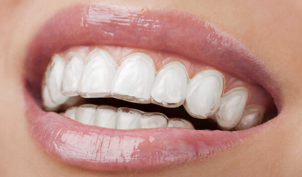 ortodoncia-invisible-invisalign-enric-pintado