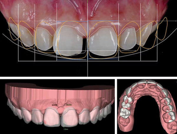 diseño-digital-de-sonrisa-dsd-barcelona-manresa