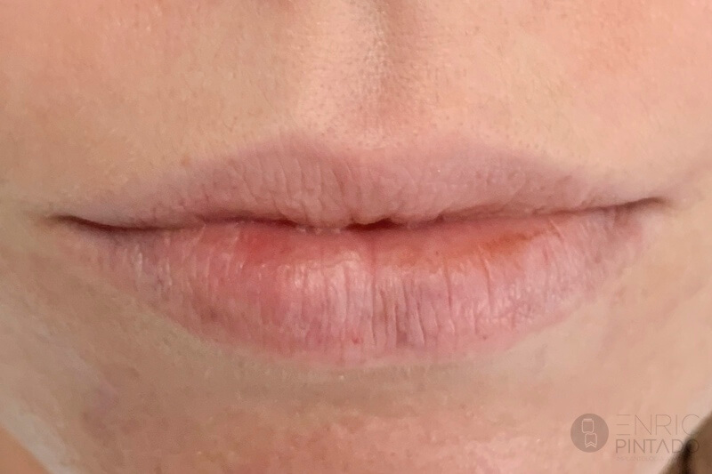aumento-labios-acido-hialuronico-antes-enric-pintado