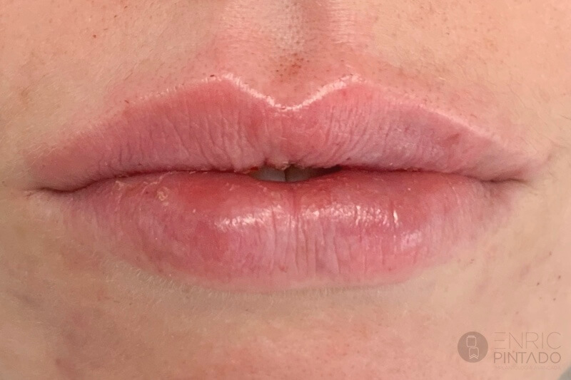 aumento-labios-acido-hialuronico-despues-enric-pintado