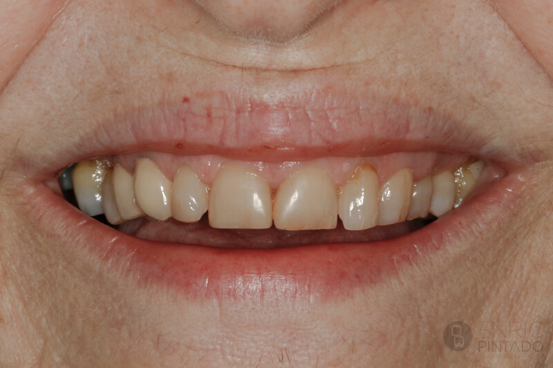 carillas-de-ceramica-caso-real-antes