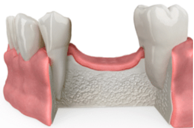 Implantes dentales para pacientes con poco hueso