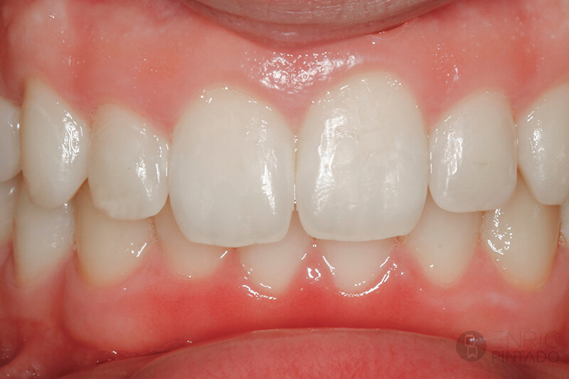 ortodoncia-caso-real-despues