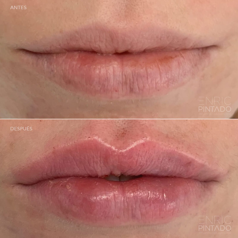 Caso Antes y Después - Aumento de labios con ácido hialurónico