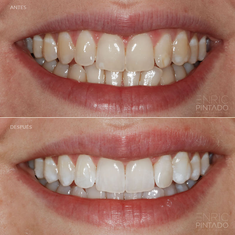 Caso Antes y Después - Blanqueamiento dental