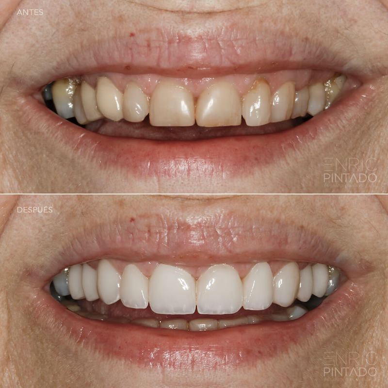 Caso Antes y después - Carillas dentales de porcelana