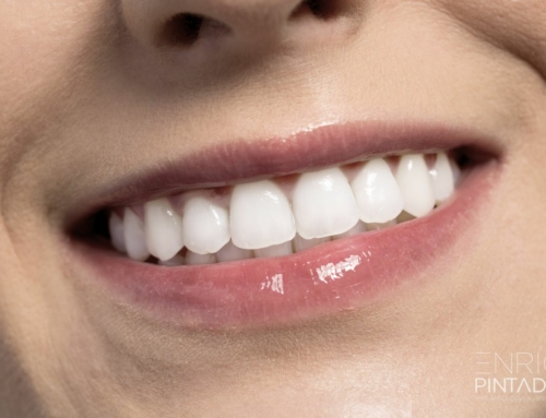 Carillas dentales: Guía completa para una sonrisa perfecta