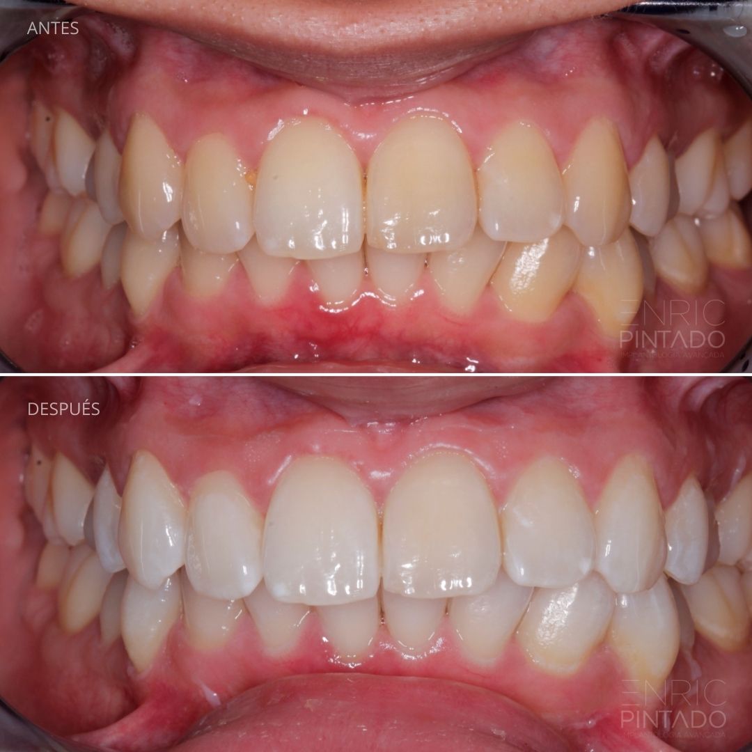 caso-blanqueamiento-dental-avanzado-barcelona-manresa-07