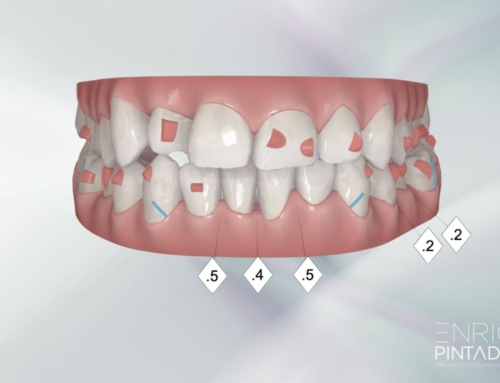 Qué es el ClinCheck de Invisalign